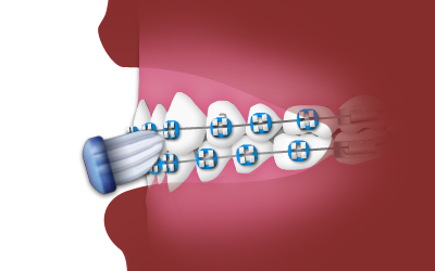 _BrushingwhileWearingBraces