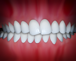 _crossbite_
