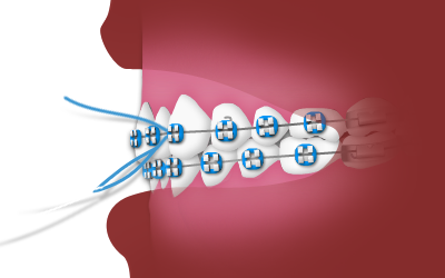 _FlossingwhileWearingBraces