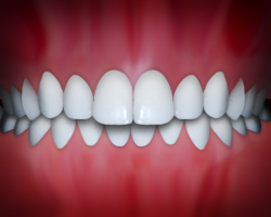 _Overbite_