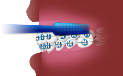 _TopicalFluoride