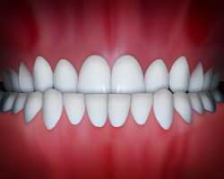 _underbite_