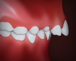 _UpperFrontTeethProtrusion_