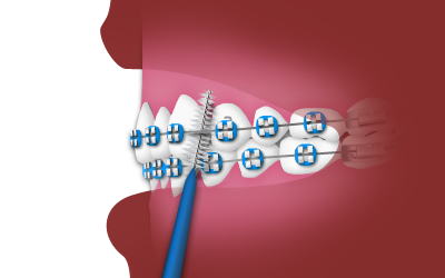 _UsinganInterdentalToothbrush