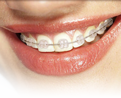 Caramic Braces