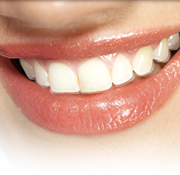 Types of Braces | David Crowder, D.D.S. | Bartlett TN